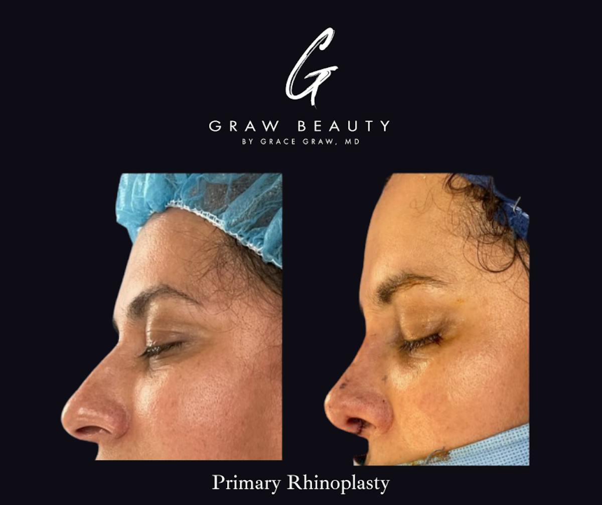 Nose Before & After Gallery - Patient 208146 - Image 1