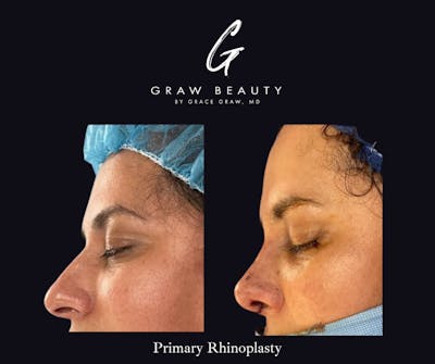 Nose Before & After Gallery - Patient 208146 - Image 1