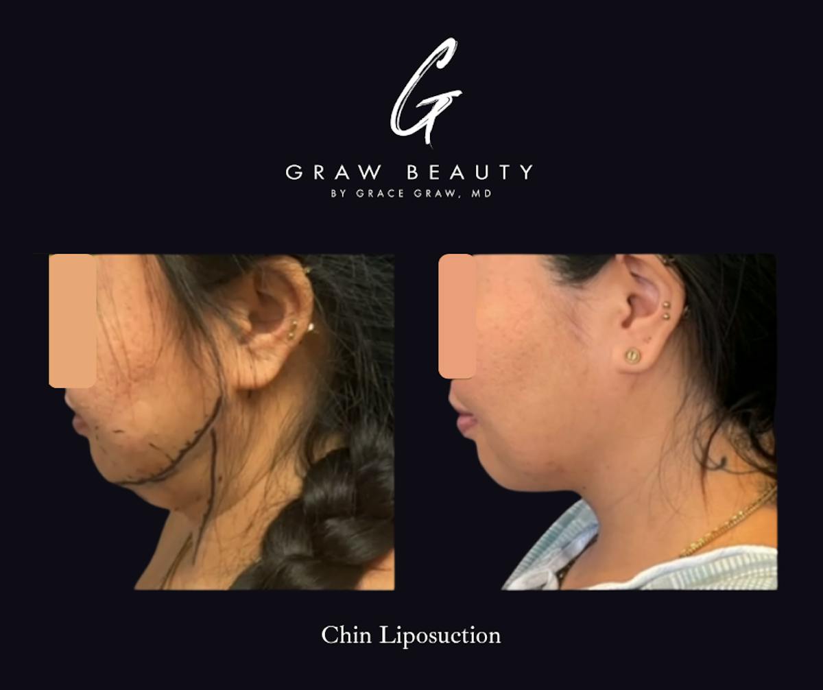 Face and Neck Before & After Gallery - Patient 408989 - Image 1