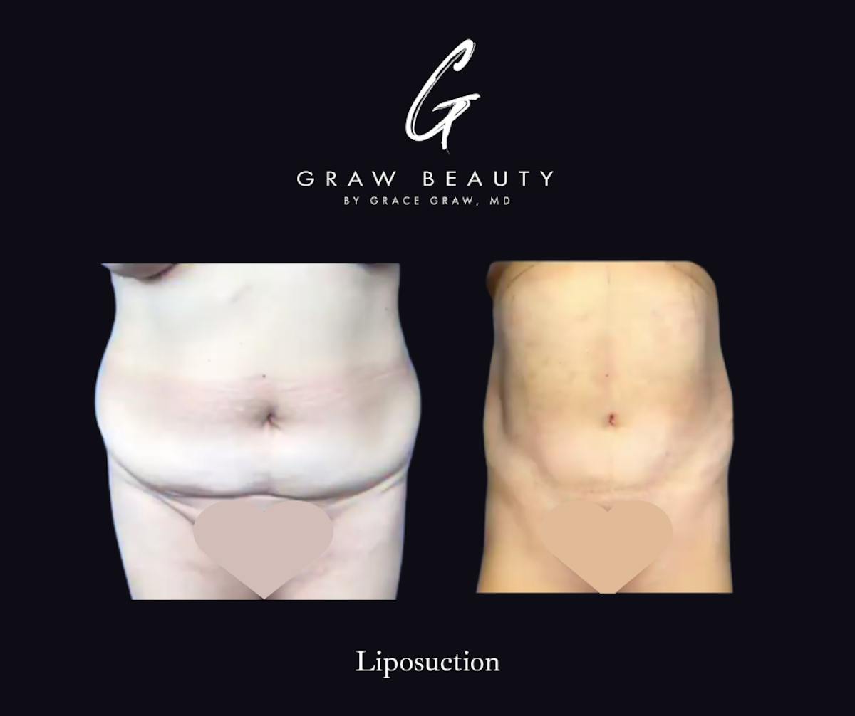 Liposuction Before & After Gallery - Patient 335311 - Image 1