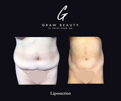 Liposuction Before & After Gallery - Patient 335311 - Image 1
