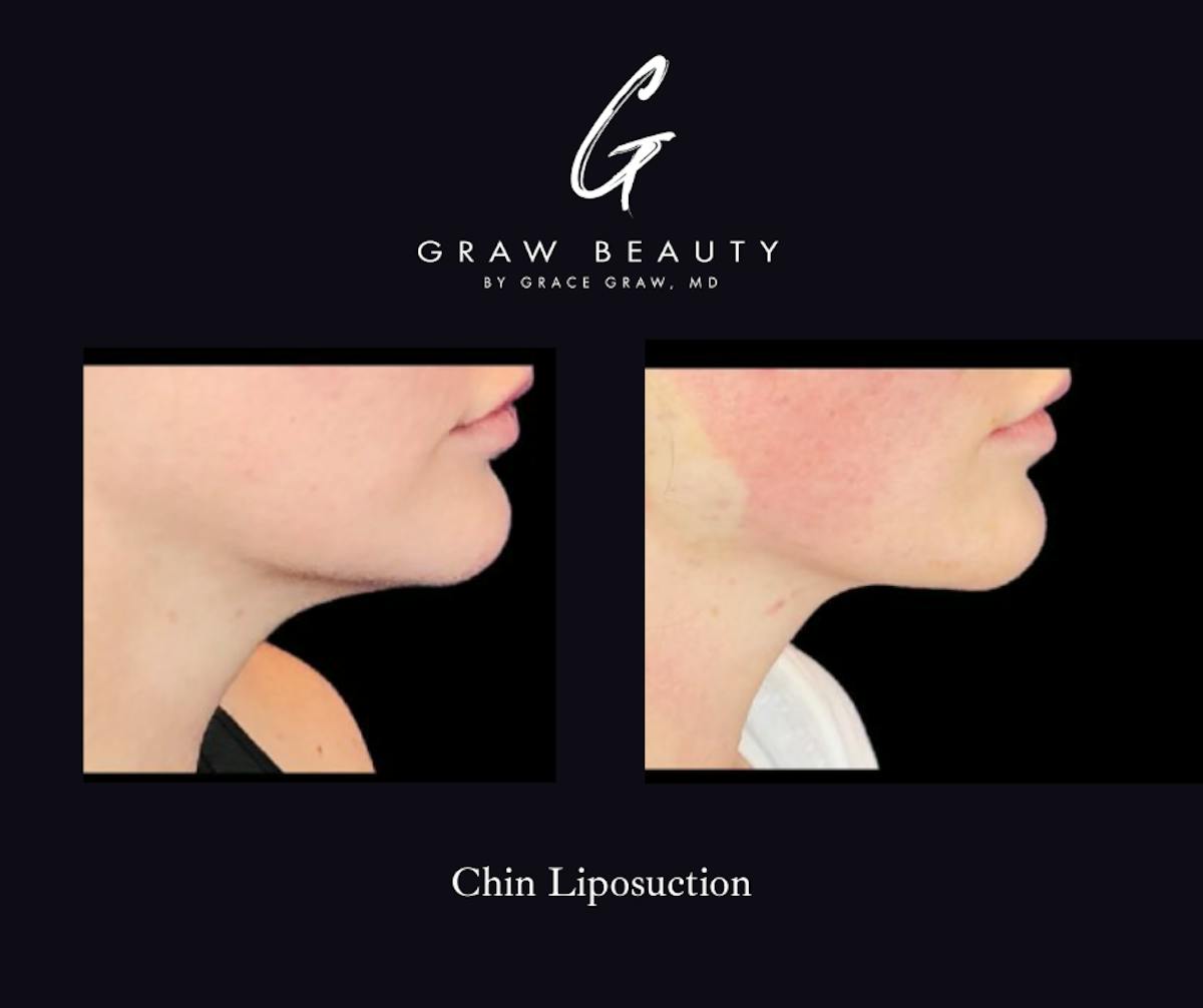 Face and Neck Before & After Gallery - Patient 767396 - Image 1