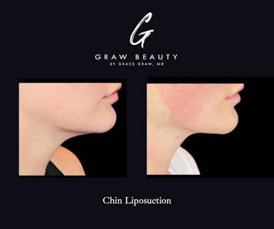 Facial Contouring / Submental Lipo Before & After Gallery - Patient 767396 - Image 1