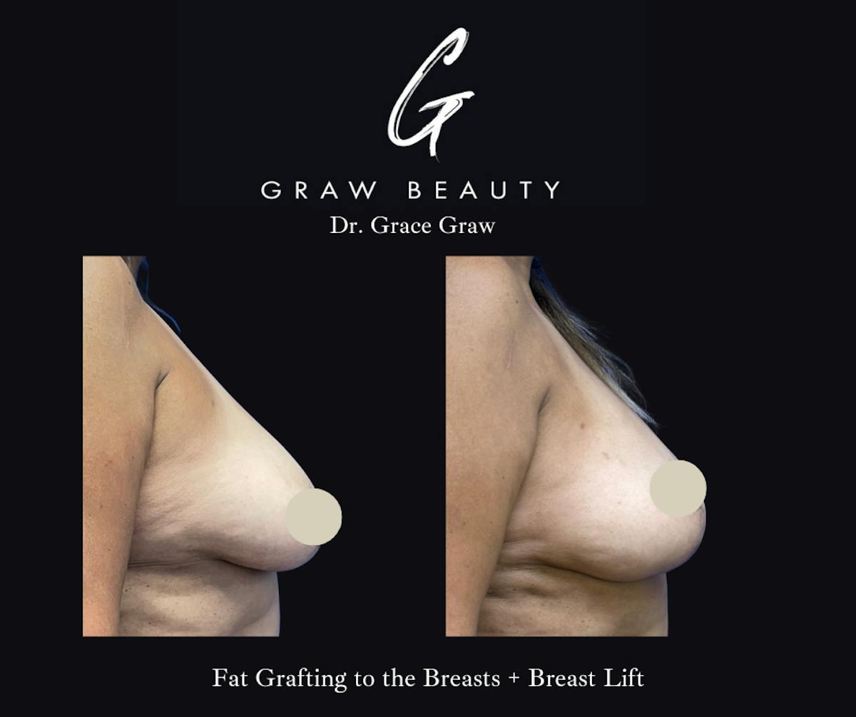 Breast Lift Before & After Gallery - Patient 161626 - Image 2