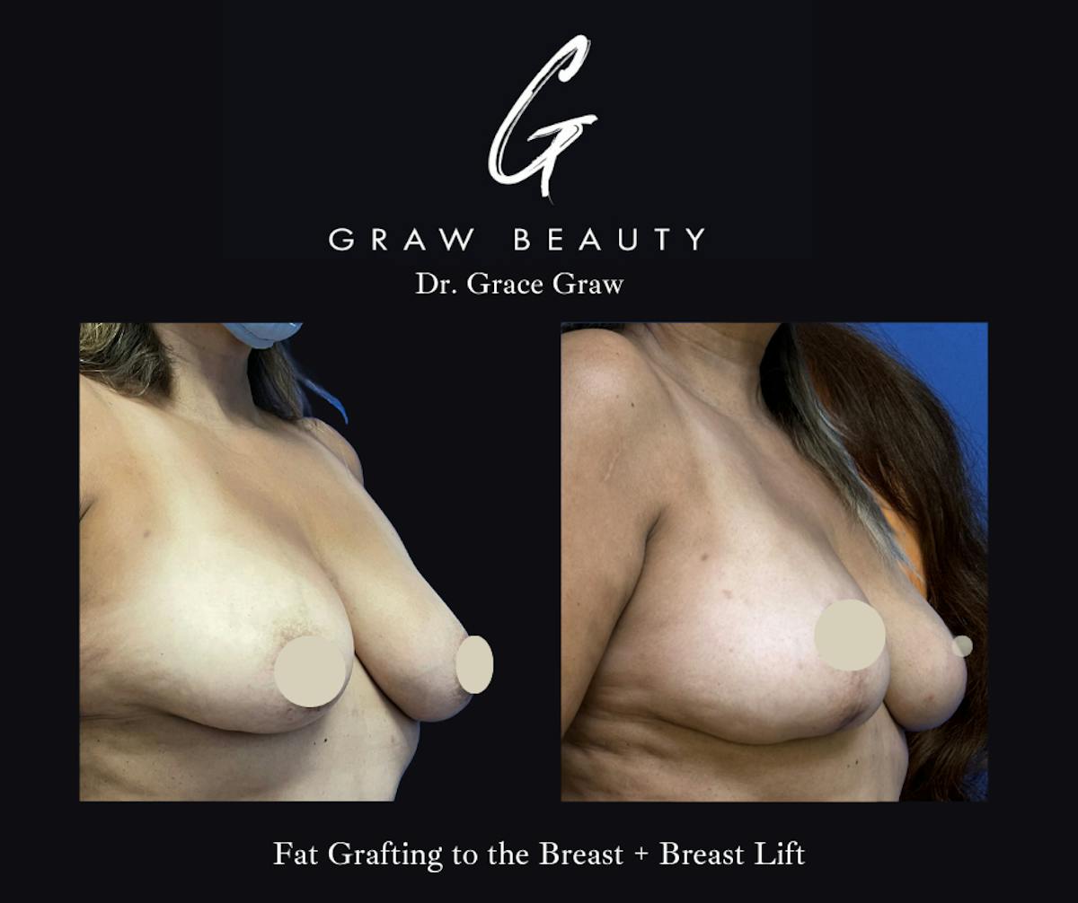 Breast Lift Before & After Gallery - Patient 161626 - Image 1