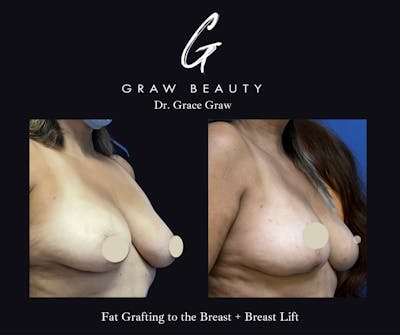 Breast Lift Before & After Gallery - Patient 161626 - Image 1