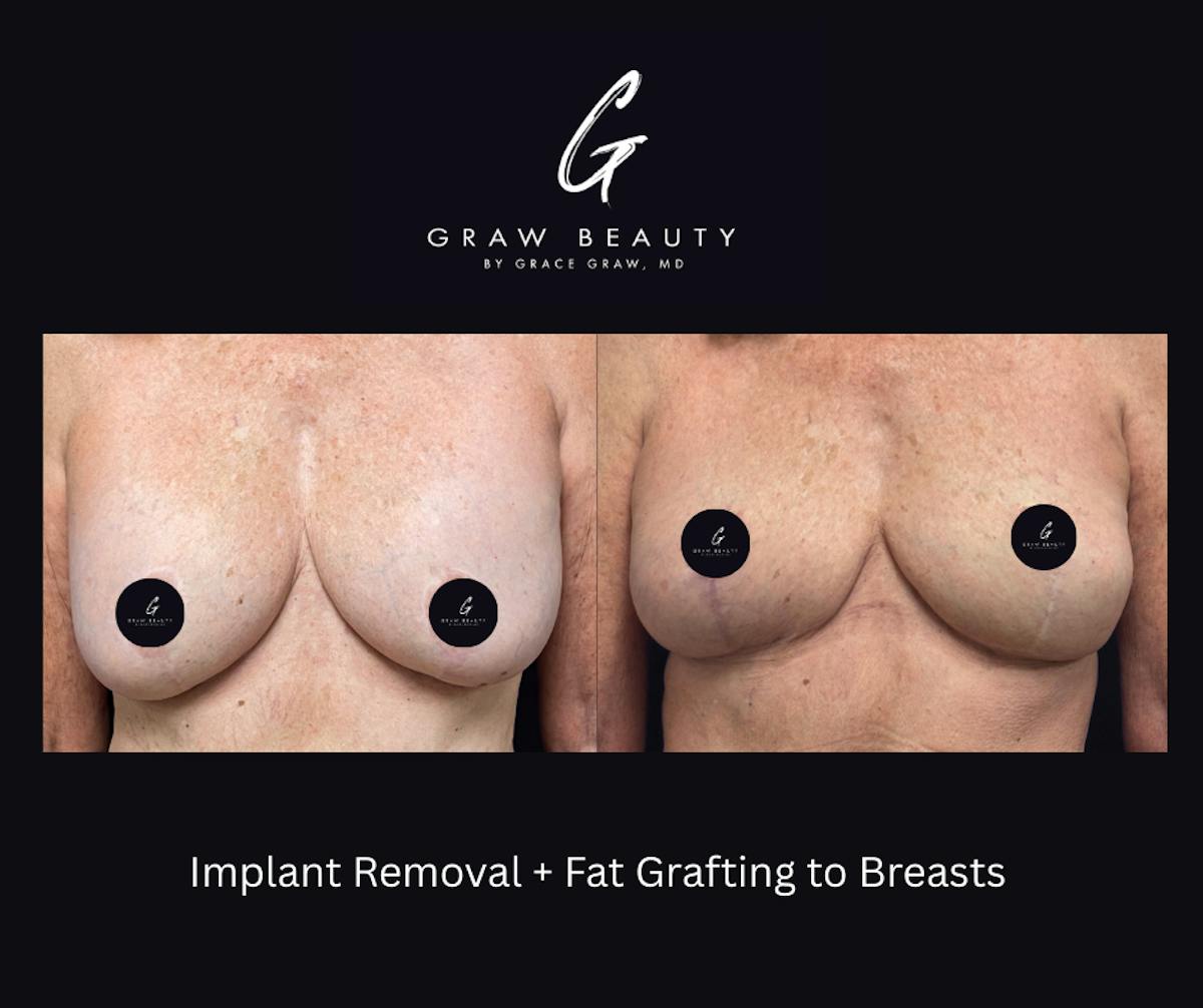 Fat Grafting Before & After Gallery - Patient 301516 - Image 1