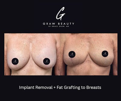 Fat Grafting Before & After Gallery - Patient 301516 - Image 1