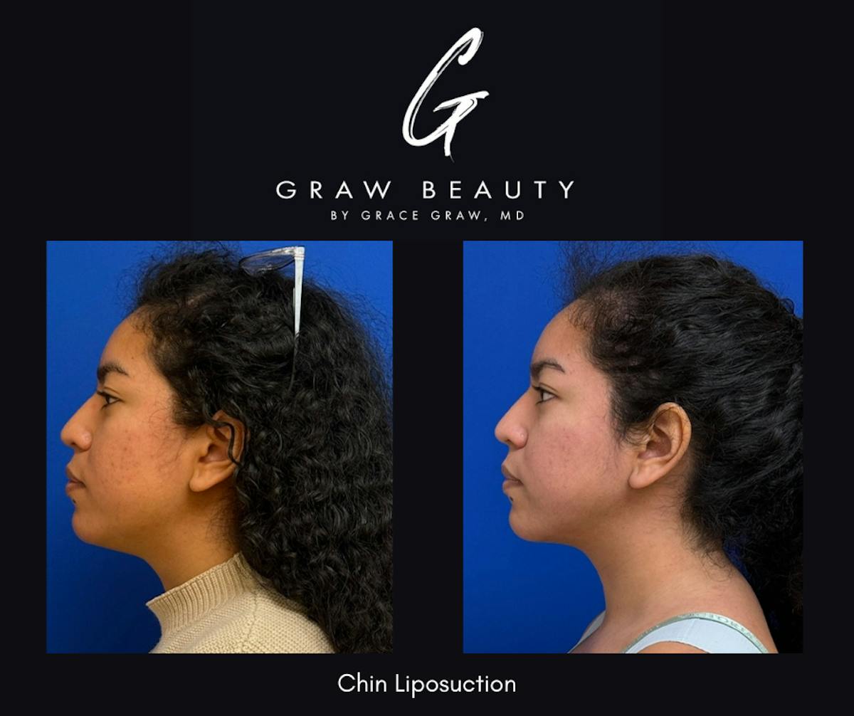 Face and Neck Before & After Gallery - Patient 380025 - Image 1