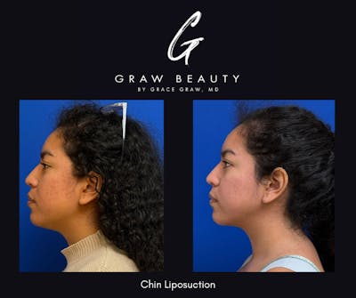 Facial Contouring / Submental Lipo Before & After Gallery - Patient 380025 - Image 1