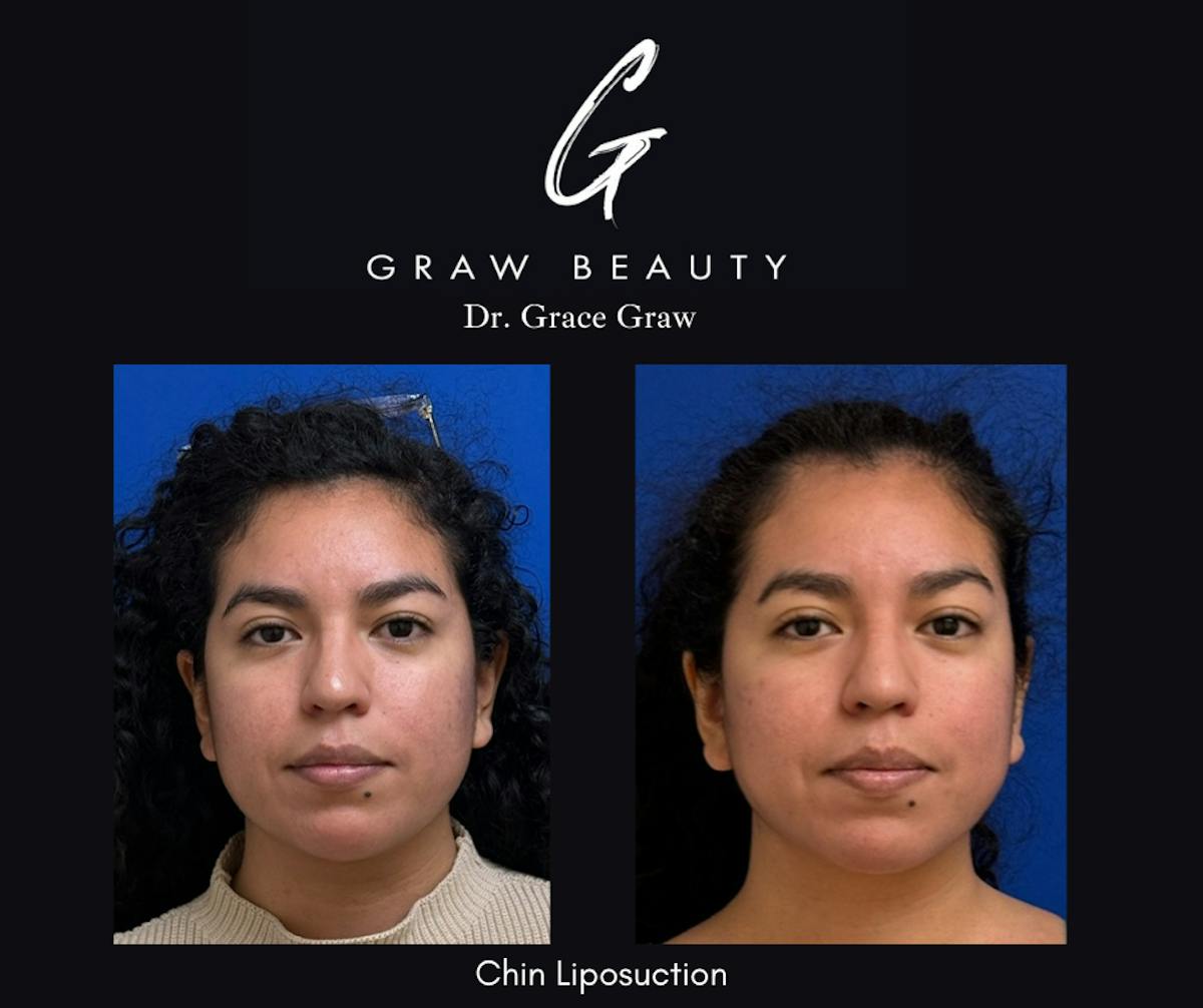 Face and Neck Before & After Gallery - Patient 380025 - Image 2