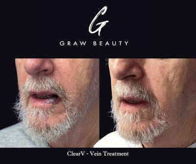 Laser Skin Resurfacing Before & After Gallery - Patient 363128 - Image 1