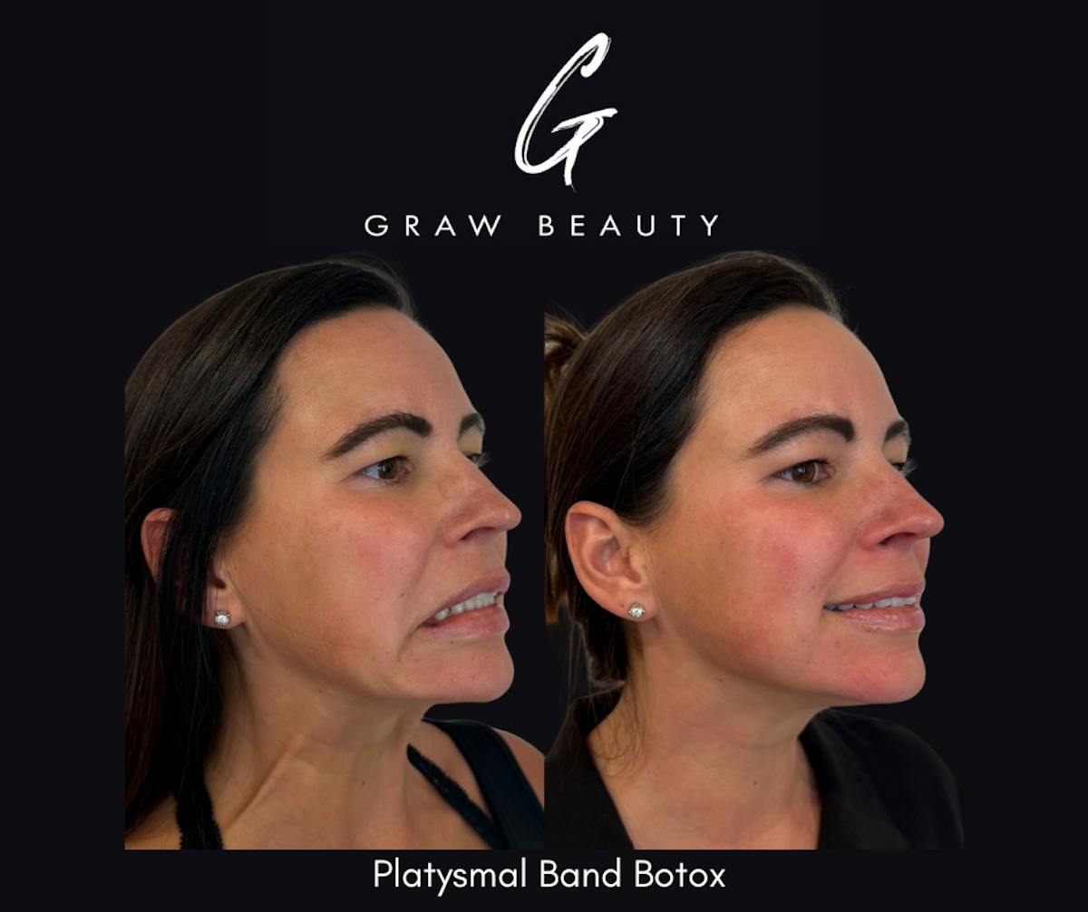 Botox/Dysport Before & After Gallery - Patient 355273 - Image 1