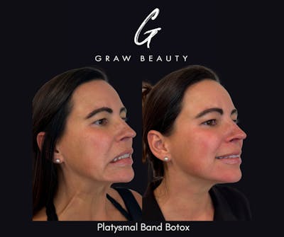 Botox/Dysport Before & After Gallery - Patient 355273 - Image 1