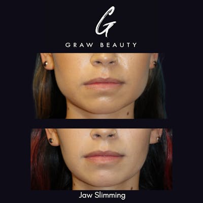 Botox/Dysport Before & After Gallery - Patient 324294 - Image 1