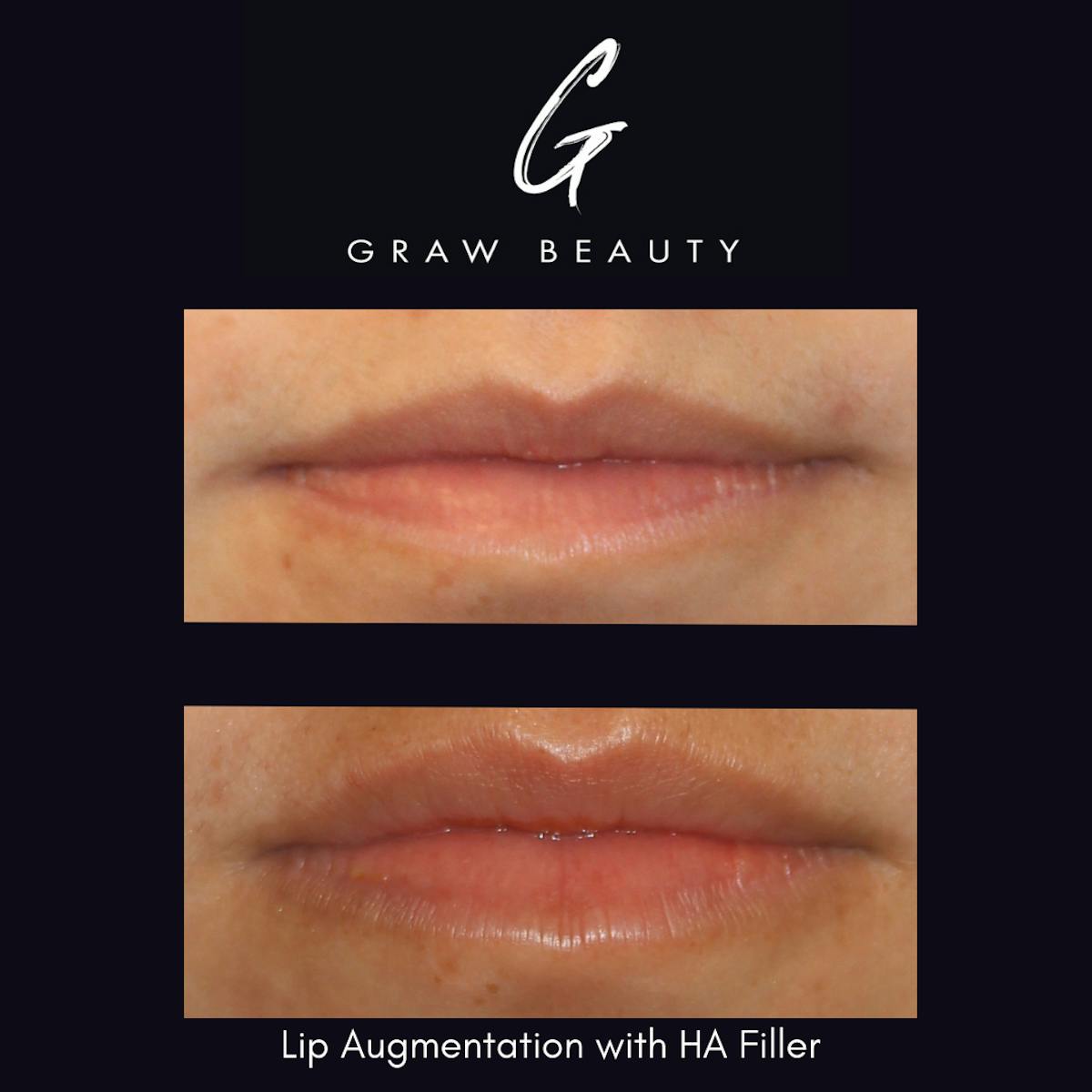 Dermal Filler Before & After Gallery - Patient 825470 - Image 1