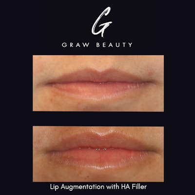 Dermal Filler Before & After Gallery - Patient 825470 - Image 1