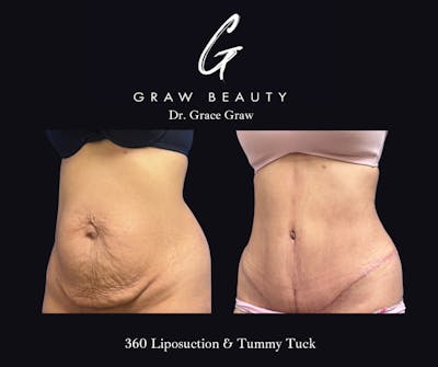 Abdominoplasty Before & After Gallery - Patient 296095 - Image 1
