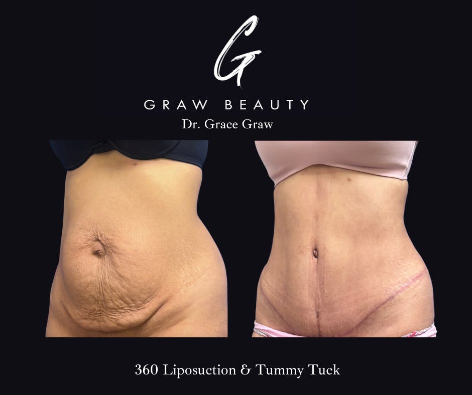 before image of liposuction patient
