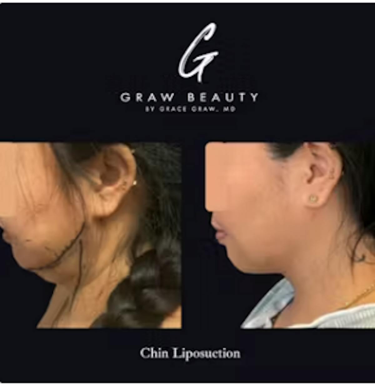 Face and Neck Before & After Gallery - Patient 987458 - Image 1