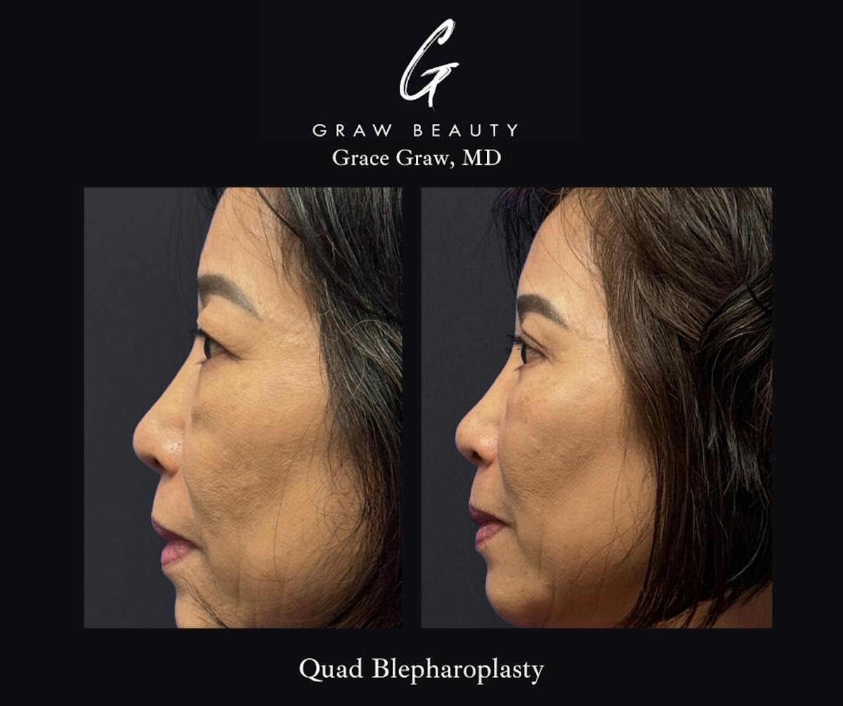 Eyelids Before & After Gallery - Patient 283911 - Image 1