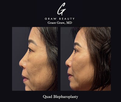 Eyelids Before & After Gallery - Patient 283911 - Image 1