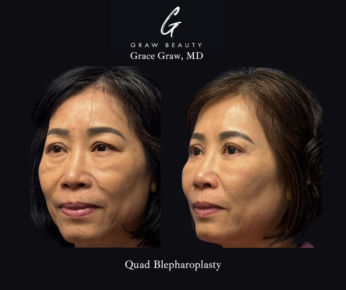 Eyelids Before & After Gallery - Patient 283911 - Image 2