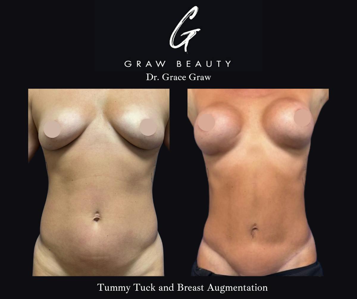 Abdominoplasty Before & After Gallery - Patient 348101 - Image 2