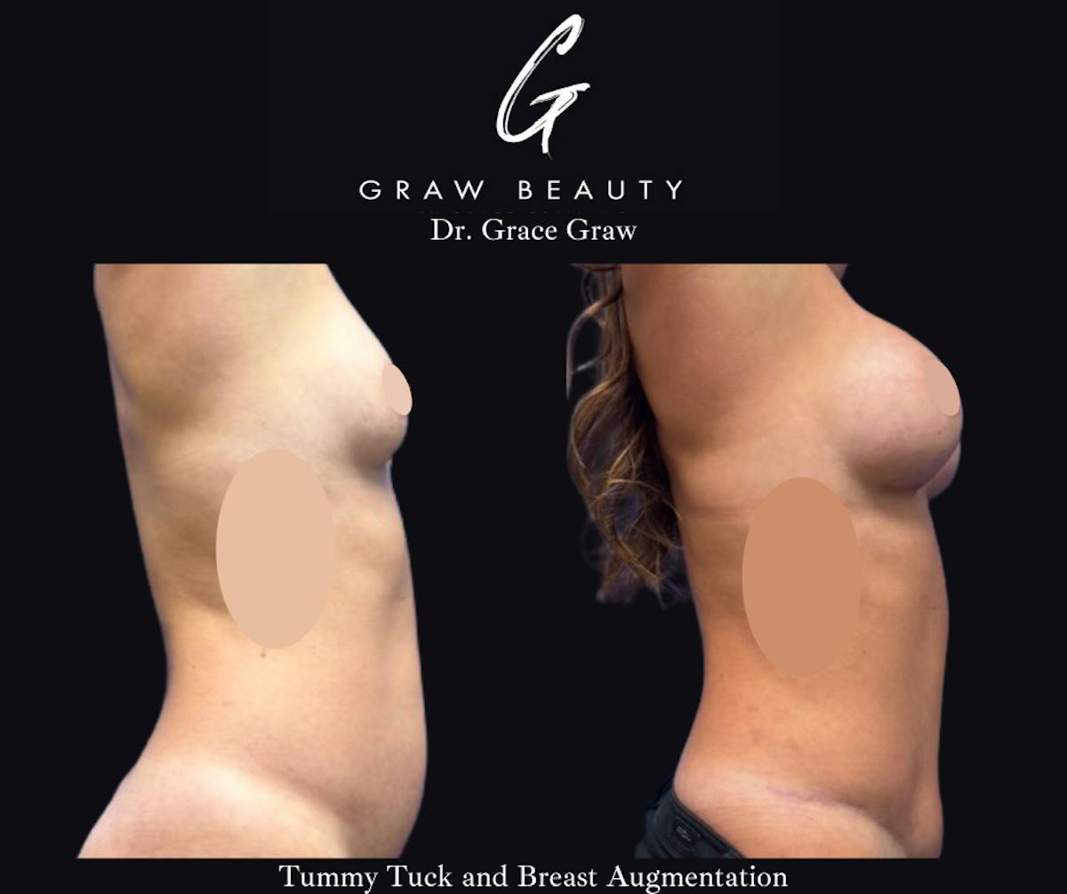 Abdominoplasty Before & After Gallery - Patient 348101 - Image 3