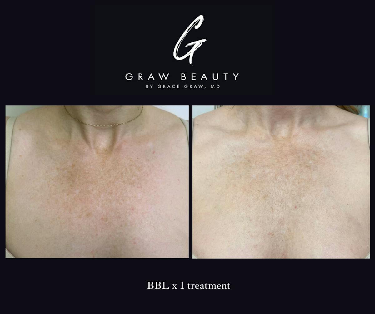 Laser Skin Resurfacing Before & After Gallery - Patient 130729 - Image 1