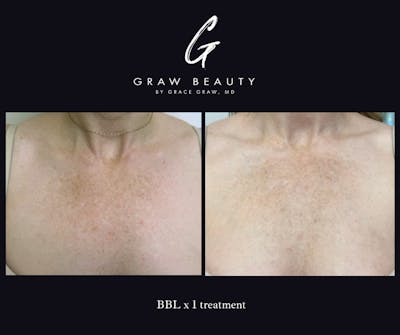 Laser Skin Resurfacing Before & After Gallery - Patient 130729 - Image 1
