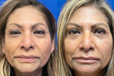 Eyelids Before & After Gallery - Patient 255482 - Image 1