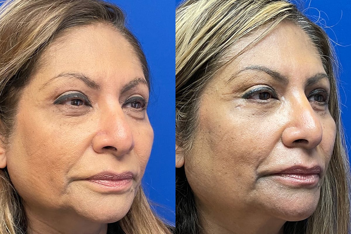 Eyelids Before & After Gallery - Patient 255482 - Image 2