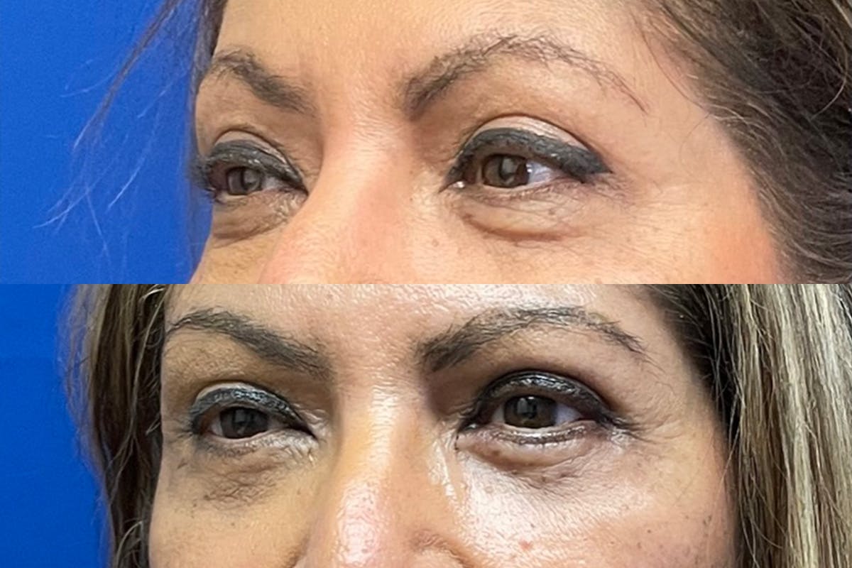 Eyelids Before & After Gallery - Patient 255482 - Image 3