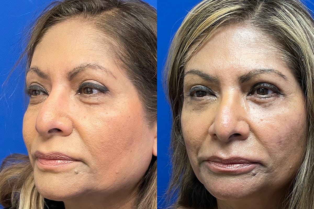 Eyelids Before & After Gallery - Patient 255482 - Image 4