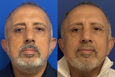 Eyelids Before & After Gallery - Patient 776066 - Image 1