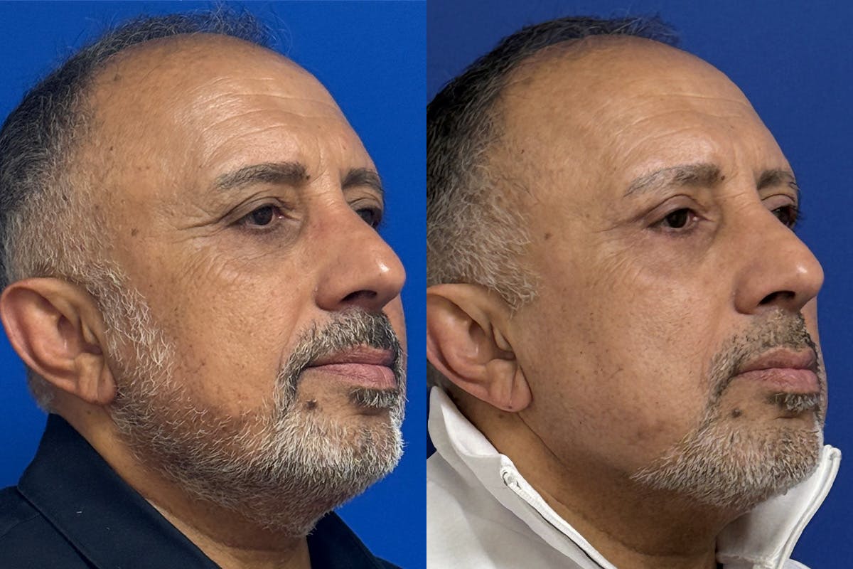 Eyelids Before & After Gallery - Patient 776066 - Image 2