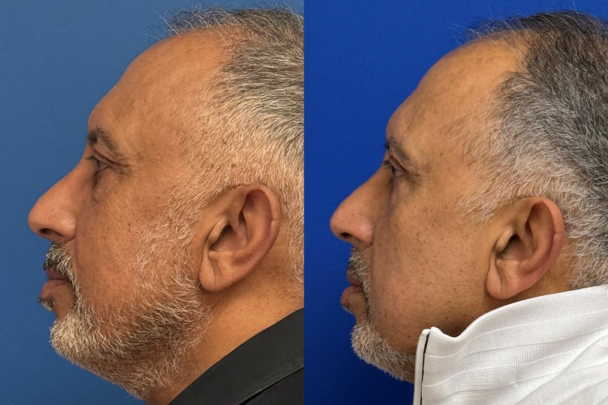 Eyelids Before & After Gallery - Patient 776066 - Image 5