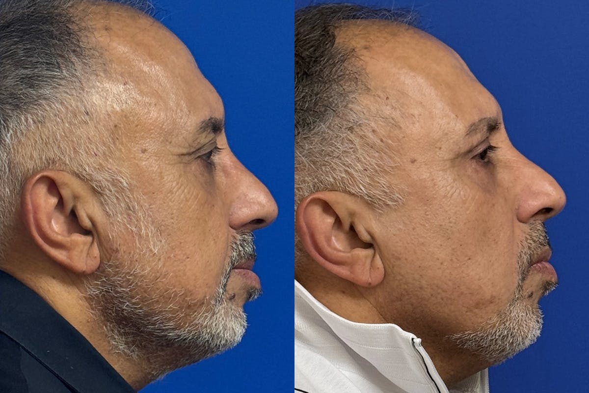 Eyelids Before & After Gallery - Patient 776066 - Image 3