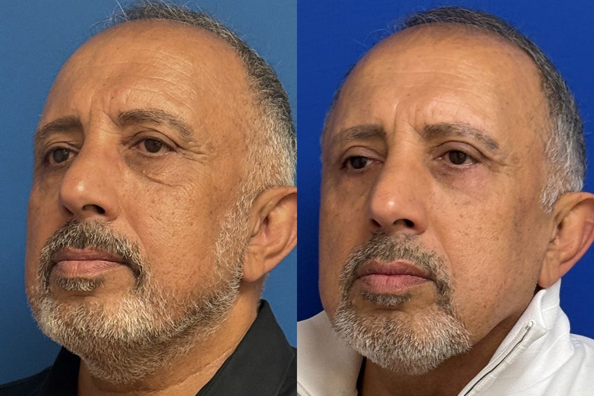 Eyelids Before & After Gallery - Patient 776066 - Image 4