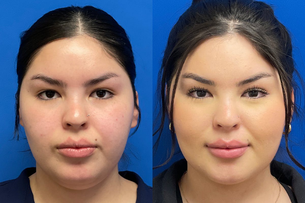 Facial Contouring / Submental Lipo Before & After Gallery - Patient 278015 - Image 1