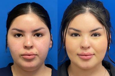 Facial Contouring / Submental Lipo Before & After Gallery - Patient 278015 - Image 1