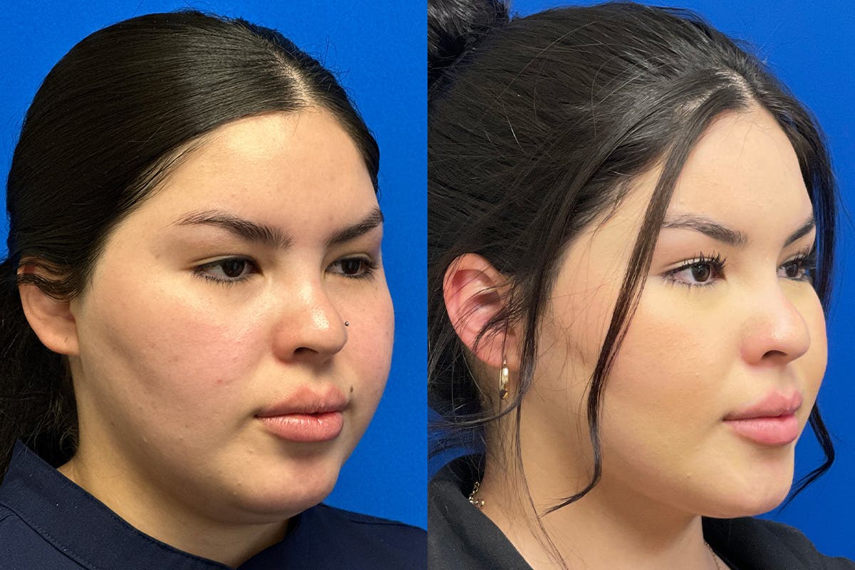 Facial Contouring / Submental Lipo Before & After Gallery - Patient 278015 - Image 2