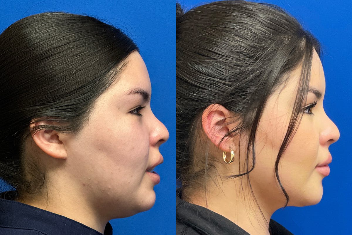 Facial Contouring / Submental Lipo Before & After Gallery - Patient 278015 - Image 3