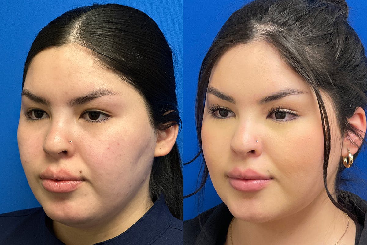 Facial Contouring / Submental Lipo Before & After Gallery - Patient 278015 - Image 4