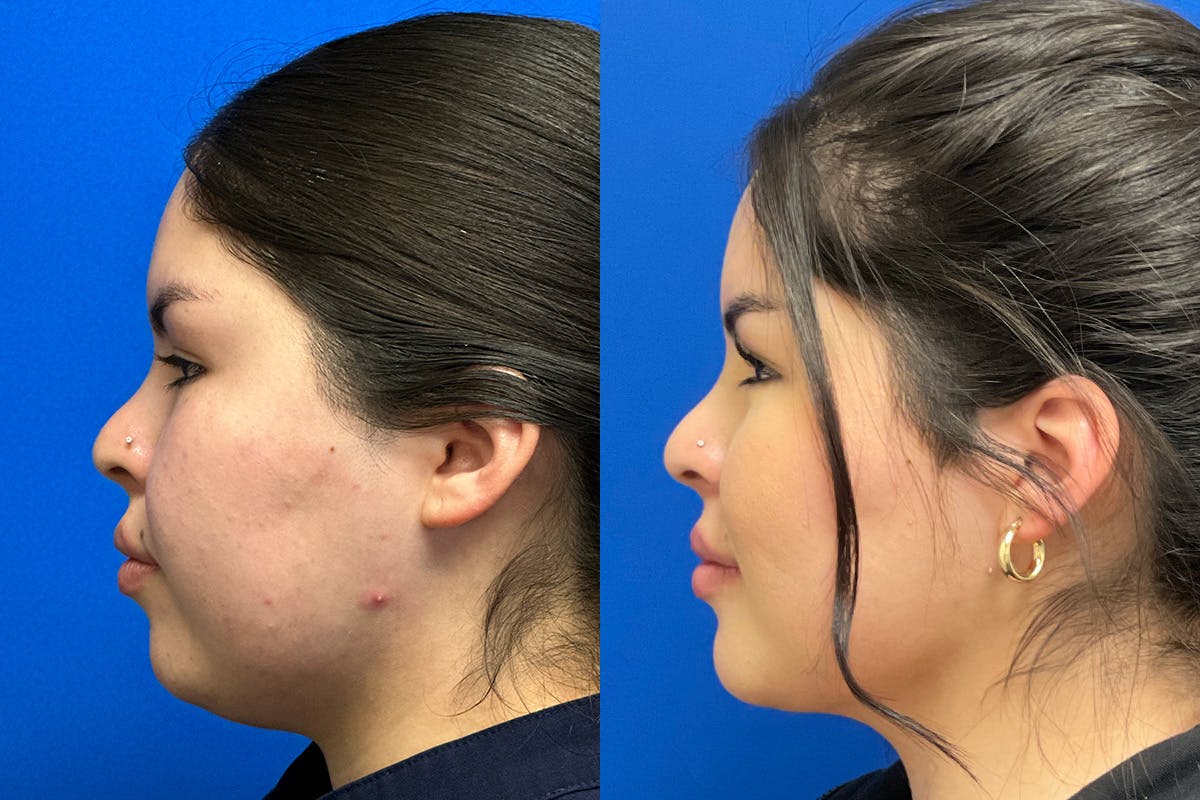 Facial Contouring / Submental Lipo Before & After Gallery - Patient 278015 - Image 5