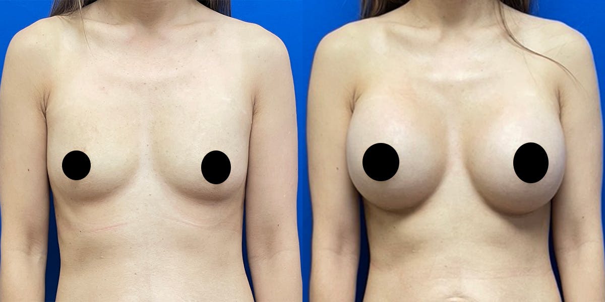 Breast Augmentation Before & After Gallery - Patient 212264 - Image 1