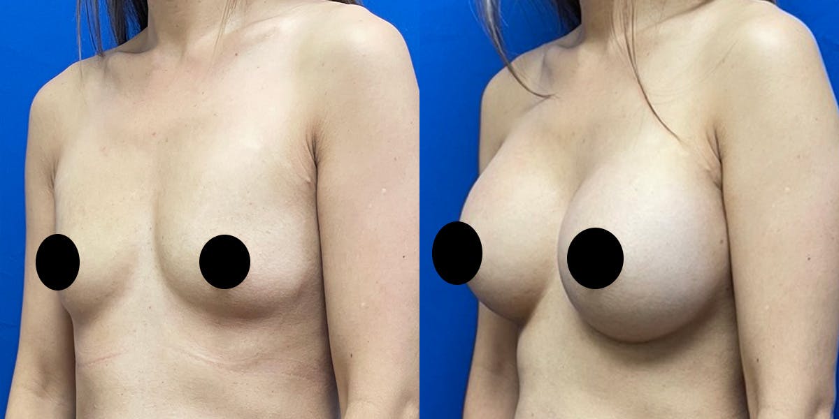 Breast Augmentation Before & After Gallery - Patient 212264 - Image 2