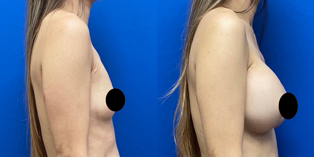 Breast Augmentation Before & After Gallery - Patient 212264 - Image 3