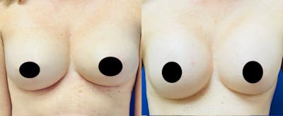 Breast Augmentation Before & After Gallery - Patient 243429 - Image 1